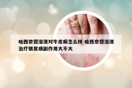 哈西奈德溶液對牛皮癬怎么樣 哈西奈德溶液治療銀屑病副作用大不大