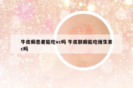 牛皮癬患者能吃vc嗎 牛皮膚癬能吃維生素c嗎