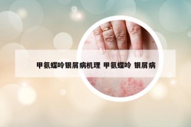 甲氨蝶呤銀屑病機(jī)理 甲氨蝶呤 銀屑病