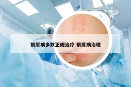 銀屑病多數(shù)正規(guī)治療 銀屑病治理