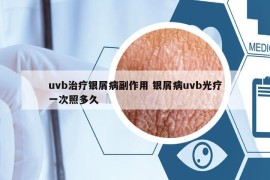 uvb治療銀屑病副作用 銀屑病uvb光療一次照多久