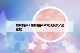 銀屑病pas 銀屑病pasi評分多少分是重度
