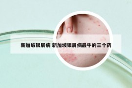 新加坡銀屑病 新加坡銀屑病最牛的三個(gè)藥