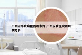 廣州治牛皮癬醫(yī)院哪家好 廣州皮膚醫(yī)院銀屑病?？? /></a>		
		</figure>

		<header class=