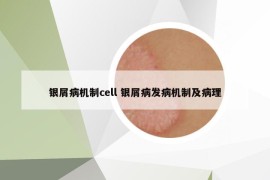 銀屑病機制cell 銀屑病發(fā)病機制及病理
