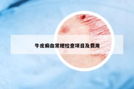 牛皮癬血常規(guī)檢查項目及費用