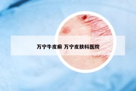 萬寧牛皮癬 萬寧皮膚科醫(yī)院