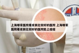 上海哪家醫(yī)院看皮膚比較好的醫(yī)院 上海哪家醫(yī)院看皮膚比較好的醫(yī)院臉上痘痘
