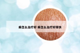 癬怎么治療好 癬怎么治療好得快