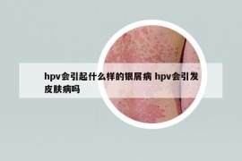 hpv會(huì)引起什么樣的銀屑病 hpv會(huì)引發(fā)皮膚病嗎