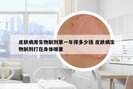 皮膚病用生物制劑第一年得多少錢 皮膚病生物制劑打在身體哪里