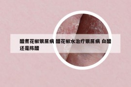 醋煮花椒銀屑病 醋花椒水治療銀屑病 白醋還是陳醋