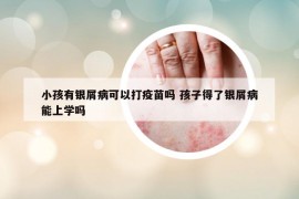 小孩有銀屑病可以打疫苗嗎 孩子得了銀屑病能上學嗎