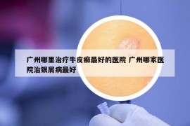 廣州哪里治療牛皮癬最好的醫(yī)院 廣州哪家醫(yī)院治銀屑病最好