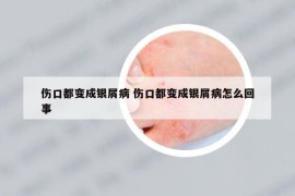傷口都變成銀屑病 傷口都變成銀屑病怎么回事