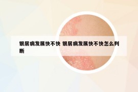銀屑病發(fā)展快不快 銀屑病發(fā)展快不快怎么判斷