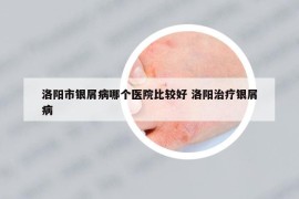 洛陽市銀屑病哪個(gè)醫(yī)院比較好 洛陽治療銀屑病