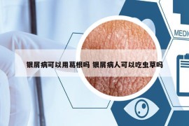 銀屑病可以用葛根嗎 銀屑病人可以吃蟲(chóng)草嗎