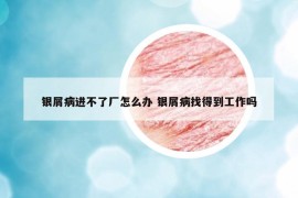 銀屑病進(jìn)不了廠怎么辦 銀屑病找得到工作嗎
