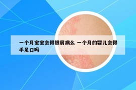 一個(gè)月寶寶會(huì)得銀屑病么 一個(gè)月的嬰兒會(huì)得手足口嗎