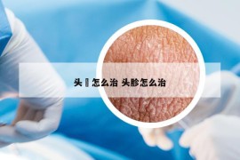 頭廯怎么治 頭胗怎么治