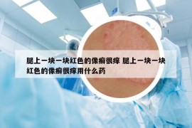 腿上一塊一塊紅色的像癬很癢 腿上一塊一塊紅色的像癬很癢用什么藥