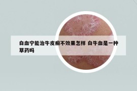 白血寧能治牛皮癬不效果怎樣 白牛血是一種草藥嗎