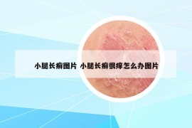 小腿長癬圖片 小腿長癬很癢怎么辦圖片