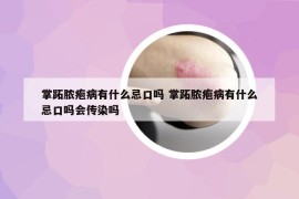 掌跖膿皰病有什么忌口嗎 掌跖膿皰病有什么忌口嗎會傳染嗎