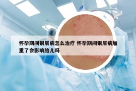 懷孕期間銀屑病怎么治療 懷孕期間銀屑病加重了會影響胎兒嗎