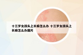 十三歲女孩頭上長癬怎么辦 十三歲女孩頭上長癬怎么辦圖片