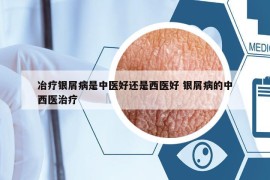 冶療銀屑病是中醫(yī)好還是西醫(yī)好 銀屑病的中西醫(yī)治療