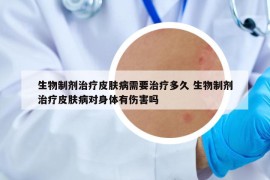 生物制劑治療皮膚病需要治療多久 生物制劑治療皮膚病對身體有傷害嗎