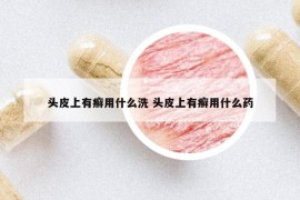 頭皮上有癬用什么洗 頭皮上有癬用什么藥