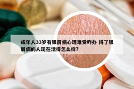 成年人33歲有銀屑病心理難受咋辦 得了銀屑病的人現(xiàn)在活得怎么樣?