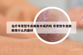 治療尋常型牛皮癬有中成藥嗎 尋常性牛皮膚癬用什么藥最好