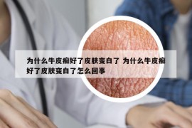為什么牛皮癬好了皮膚變白了 為什么牛皮癬好了皮膚變白了怎么回事