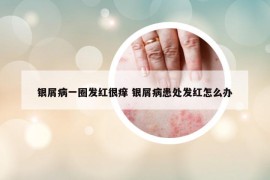 銀屑病一圈發(fā)紅很癢 銀屑病患處發(fā)紅怎么辦