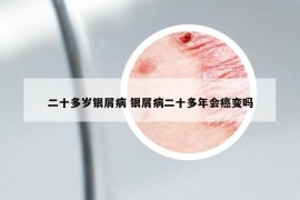 二十多歲銀屑病 銀屑病二十多年會癌變嗎