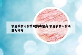 銀屑病會(huì)不會(huì)出現(xiàn)梅毒偏高 銀屑病會(huì)不會(huì)誤查為梅毒