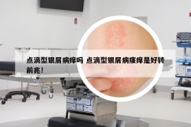點滴型銀屑病癢嗎 點滴型銀屑病瘙癢是好轉前兆!