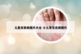 兒童皮膚癬圖片大全 小兒常見皮癬圖片