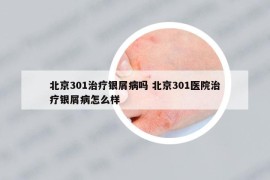 北京301治療銀屑病嗎 北京301醫(yī)院治療銀屑病怎么樣