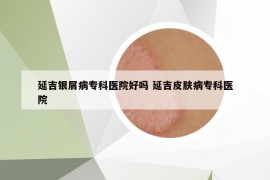 延吉銀屑病?？漆t(yī)院好嗎 延吉皮膚病專科醫(yī)院