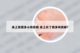 身上有很多小塊狀癬 身上長了很多塊狀癬?