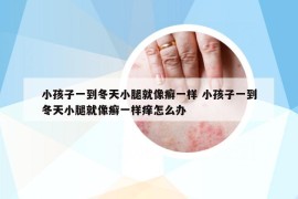 小孩子一到冬天小腿就像癬一樣 小孩子一到冬天小腿就像癬一樣癢怎么辦