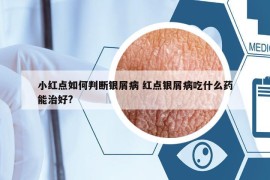 小紅點(diǎn)如何判斷銀屑病 紅點(diǎn)銀屑病吃什么藥能治好?