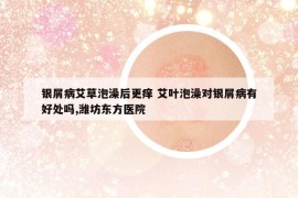 銀屑病艾草泡澡后更癢 艾葉泡澡對(duì)銀屑病有好處嗎,濰坊東方醫(yī)院