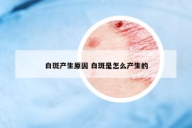 白斑產(chǎn)生原因 白斑是怎么產(chǎn)生的