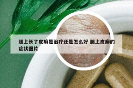 腿上長(zhǎng)了皮癬是治療還是怎么好 腿上皮癬的癥狀圖片